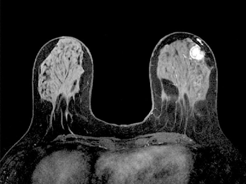 МРТ снимок рак молочных желез