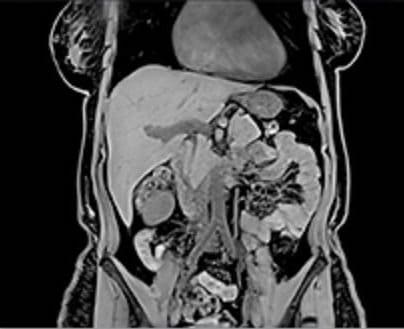 МРТ снимок кишечника