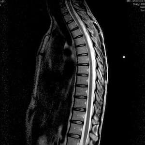 МРТ позвоночника (спины) - что показывает и чем может помочь