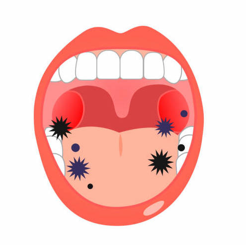Как самостоятельно обнаружить рак полости рта: советы стоматолога Как самостоятельно обнаружить рак полости рта советы стоматолога